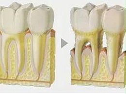 牙齿矫正会造成牙龈萎缩吗?