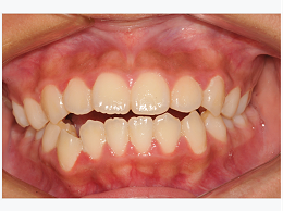 牙齿矫正多久才能治疗好?