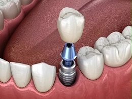 “种植牙”凭什么成为牙齿缺失较好的修复方式？