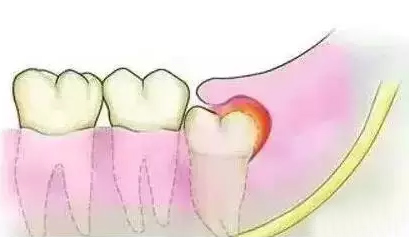 智齿萌发导致牙龈红肿发炎