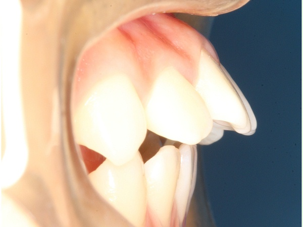 龅牙
