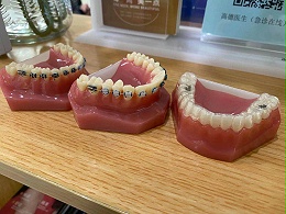 高德口腔：牙齿矫正什么牙套好?