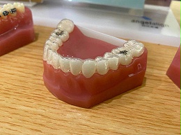 成都牙齿矫正时间是多久？