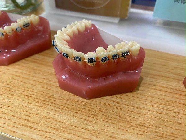 牙齿矫正