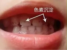 小朋友牙齿上的黑色素能去掉吗？
